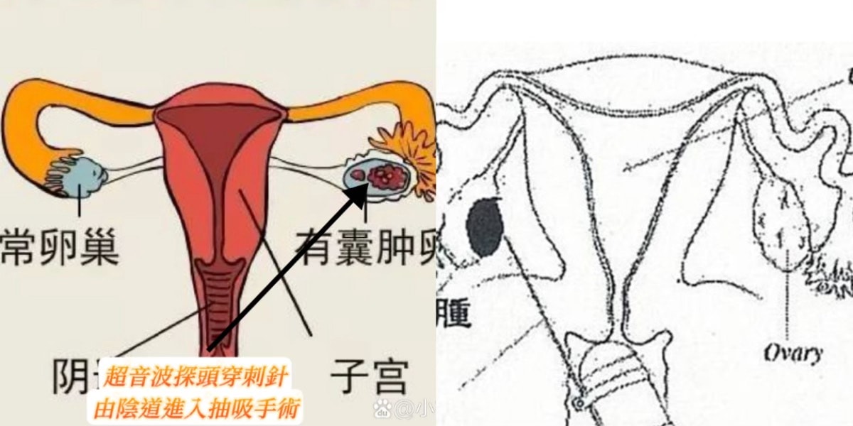 巧克力囊腫抽吸費用/腹腔鏡手術/抽除硬化囊腫/Lantis的奇言妙語 - 第6張圖