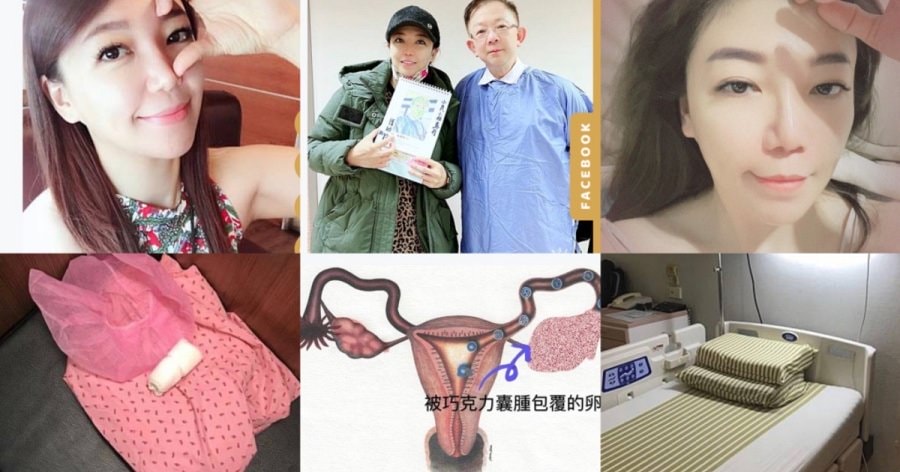淺談巧克力囊腫抽取tvsae手術(下)什麼!!妳巧克力囊腫又復發了~~ - 第1張圖